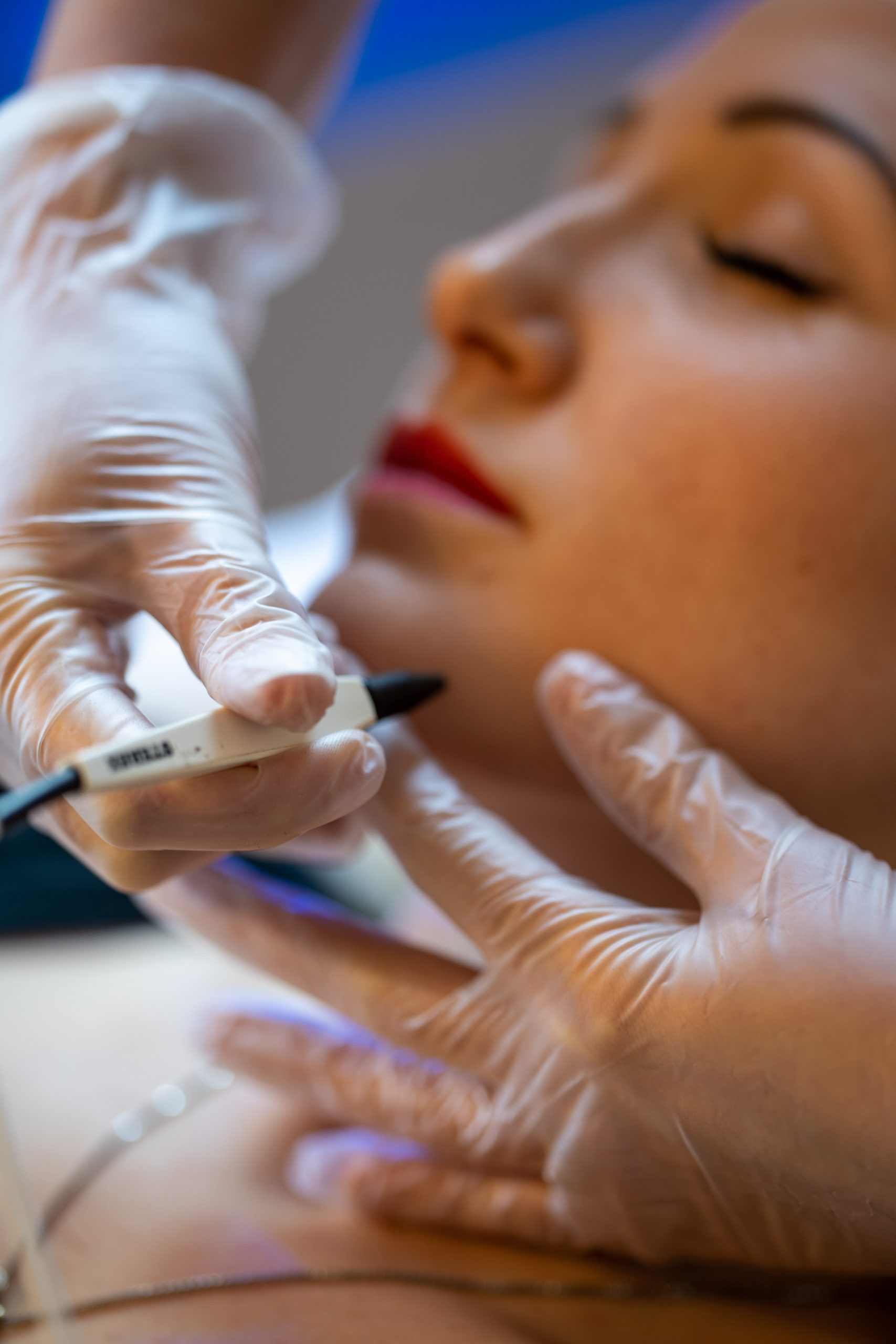 ACP Blemish Removal